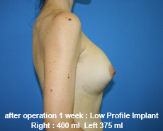 plastic-surgery-breast-augmentation